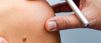 Cáncer de piel: ¿Cómo identificar un lunar sospechoso?
