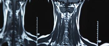 Cáncer de cabeza y cuello: prevención y tratamiento