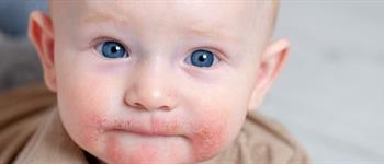Dermatitis atópica: ¿Por qué se enrojece la piel de mi hijo?