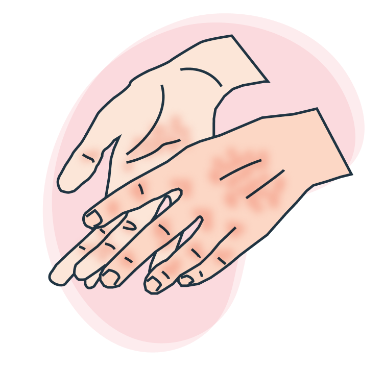 Icono manos con dermatitis.
