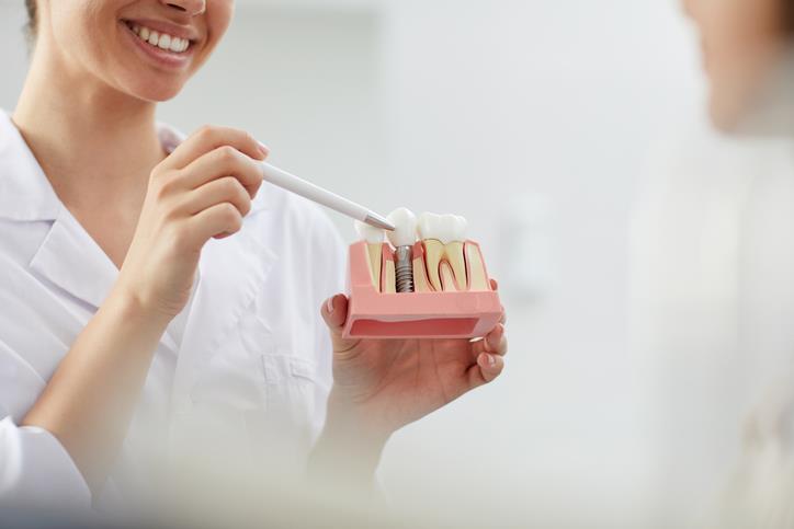 Implantes dentales, la respuesta a la pérdida de dientes