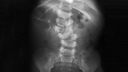 columna+infantil columna+infantil