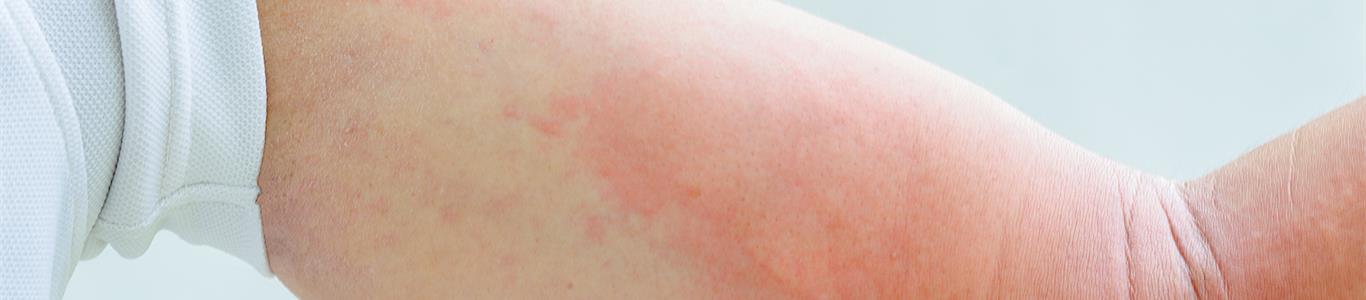 Semana Mundial de la Alergia: la lucha contra la molesta urticaria
