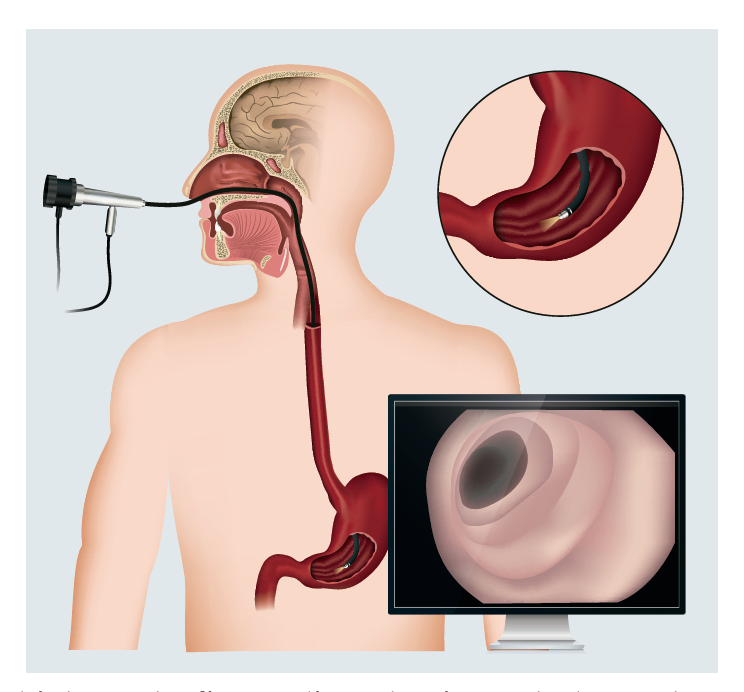 Endoscopia