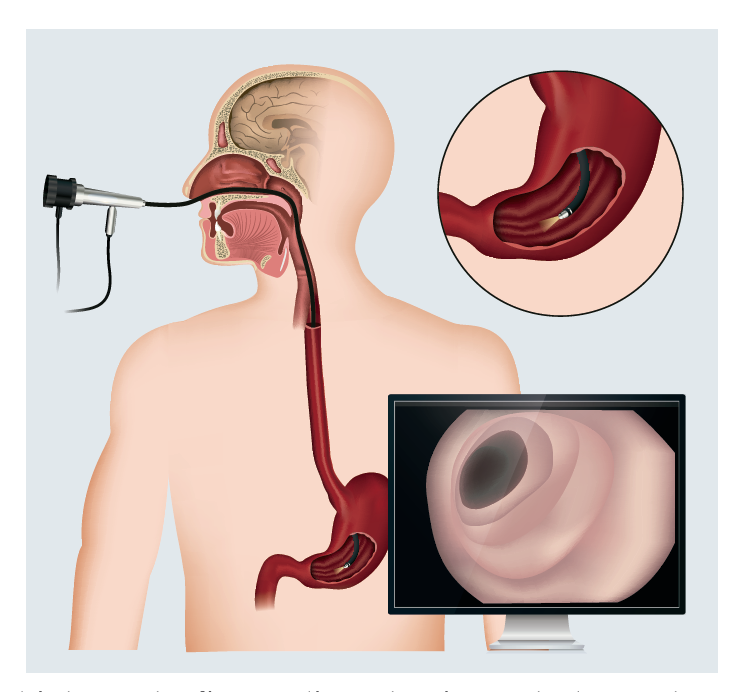 endoscopia_digestiva Endoscopía
