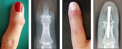 Artritis en los dedos: ¿cómo se siente? Causas y tratamiento