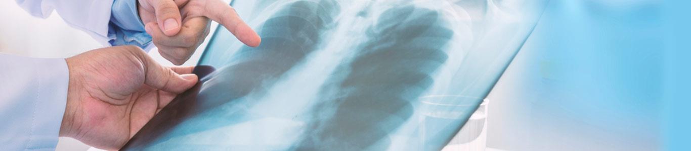 Nódulos pulmonares: No siempre piense en lo peor