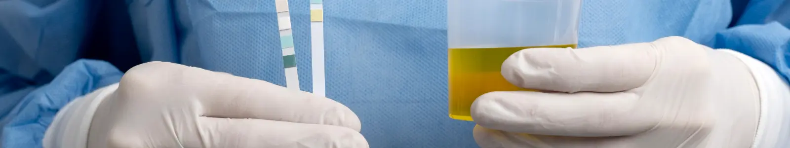Análisis de muestra de orina para el diagnóstico de infecciones urinarias, una afección frecuente durante la temporada de invierno.