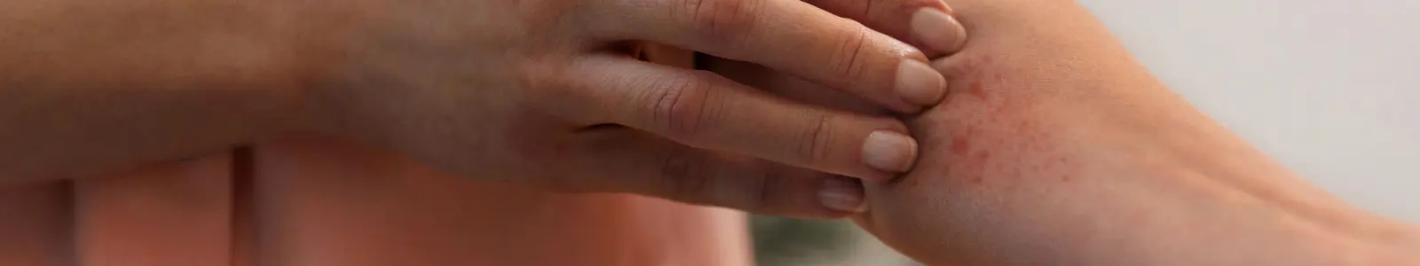 Persona con lesiones y enrojecimiento en la piel, síntomas característicos del herpes zóster.